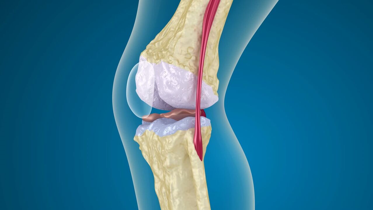 zničenie kolenného kĺbu s artrózou