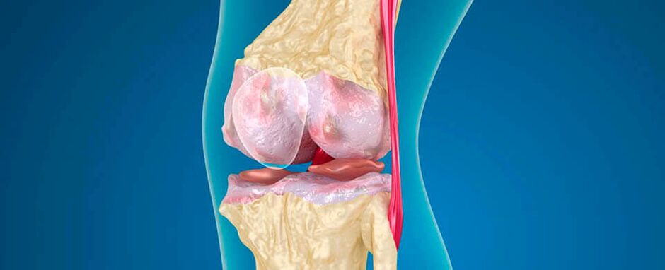 artróza kolena ako príčina bolesti