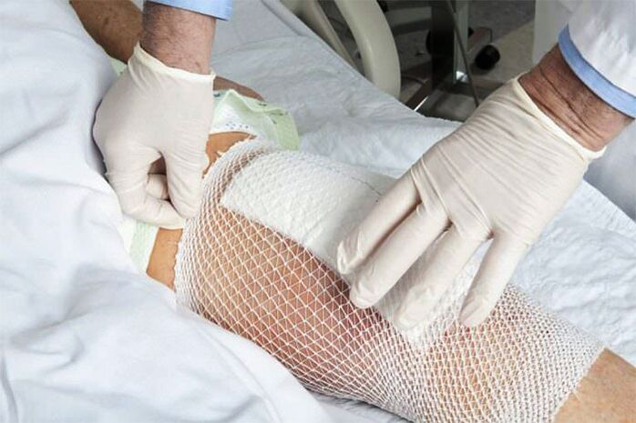 Terapeutický obklad na artrózu kolenného kĺbu
