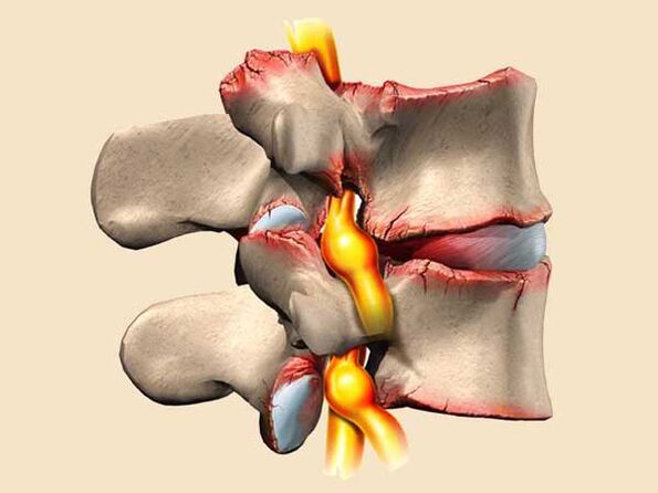 poranenie chrbtice pri hrudnej osteochondróze