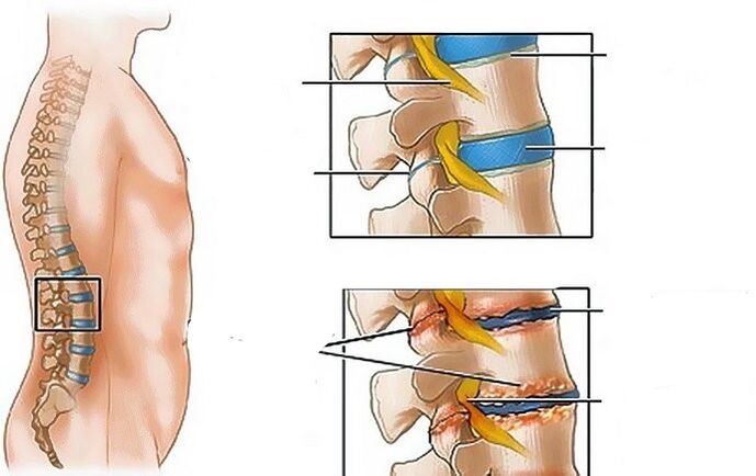 Osteochondróza bedrovej oblasti