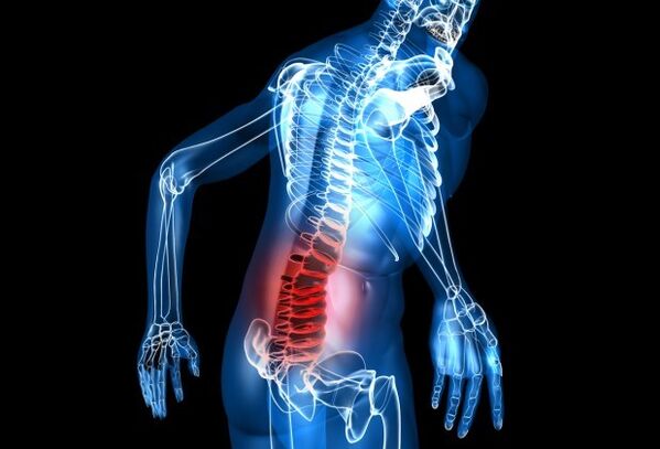 Príznaky osteochondrózy