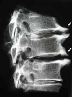 Osteofyty krčnej chrbtice spôsobujú bolesť krku