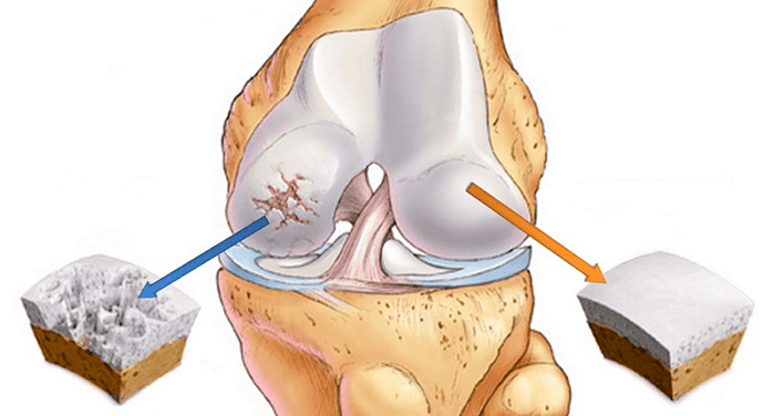 zdravá chrupavka a chrupavka postihnutá artrózou