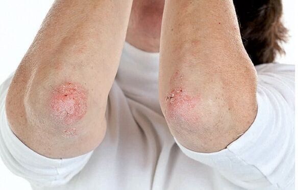 Ľudia so psoriázou sú náchylní na psoriatickú artritídu