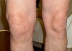 príznaky kolena