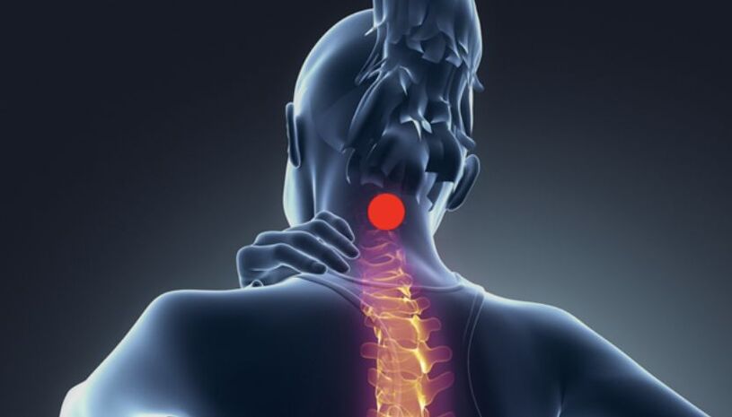 príznaky cervikálnej osteochondrózy