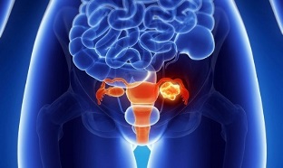 provokujúce faktory pre rozvoj osteochondrózy bedrovej chrbtice