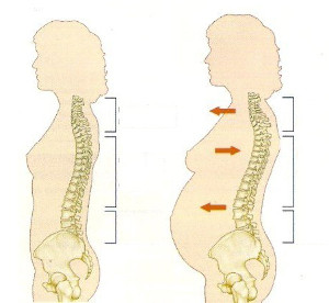 osteochondróza počas tehotenstva