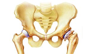 prečo vzniká artróza bedrového kĺbu